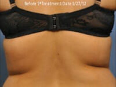 Exilis Ultra Before & After Gallery - Patient 9605637 - Image 1