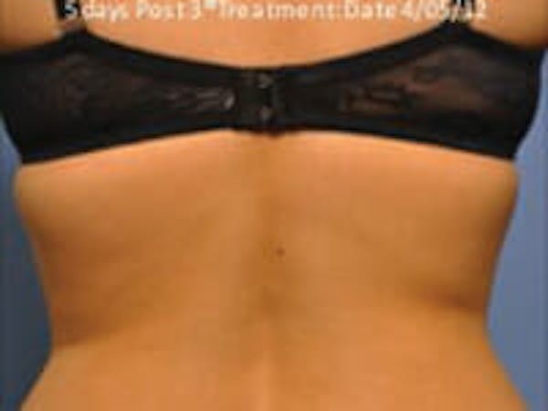Exilis Ultra Before & After Gallery - Patient 9605637 - Image 2