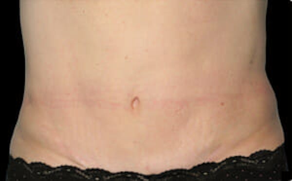 CoolSculpting® Elite Before & After Gallery - Patient 9605639 - Image 2