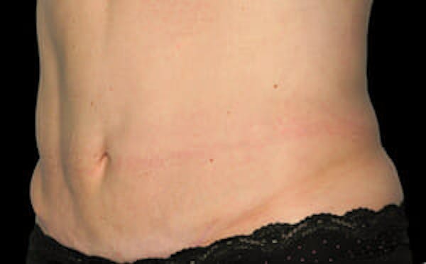 CoolSculpting® Gallery - Patient 9605639 - Image 4