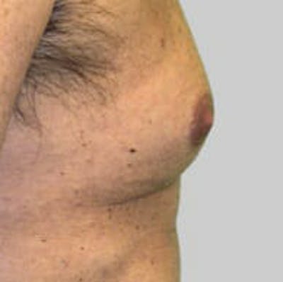 Exilis Ultra Before & After Gallery - Patient 9605650 - Image 1
