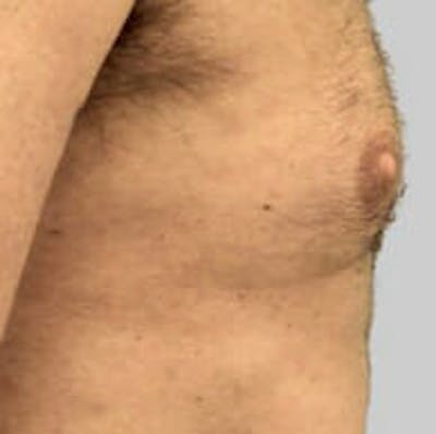 Exilis Ultra Before & After Gallery - Patient 9605650 - Image 2