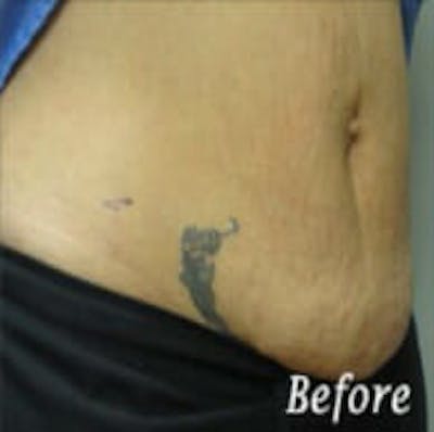 Exilis Ultra Before & After Gallery - Patient 9605653 - Image 1