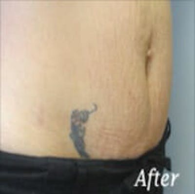 Exilis Ultra Before & After Gallery - Patient 9605653 - Image 2