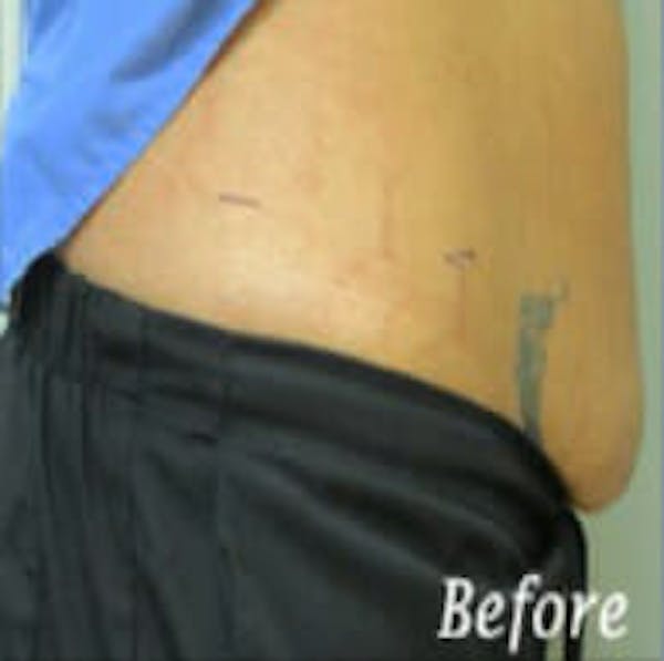 Exilis Ultra Gallery - Patient 9605653 - Image 3