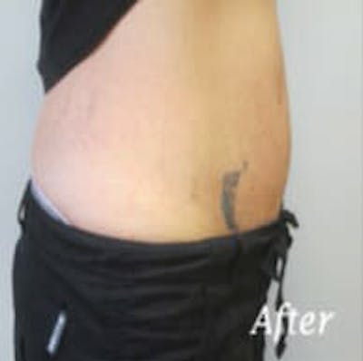 Exilis Ultra Before & After Gallery - Patient 9605653 - Image 4