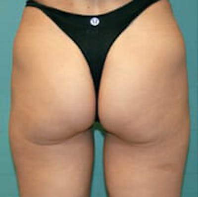 Exilis Ultra Before & After Gallery - Patient 9605655 - Image 2