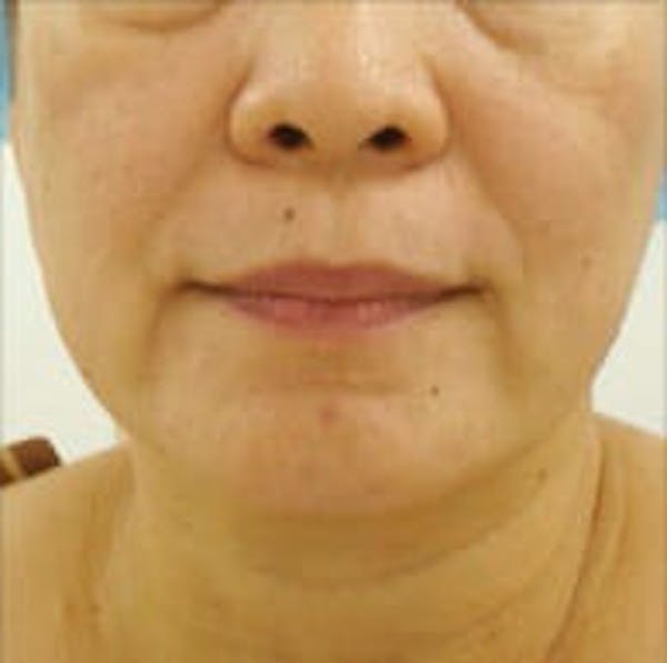 Exilis Ultra Before & After Gallery - Patient 9605657 - Image 1