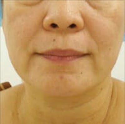 Exilis Ultra Before & After Gallery - Patient 9605657 - Image 1