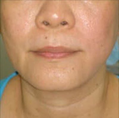 Exilis Ultra Before & After Gallery - Patient 9605657 - Image 2