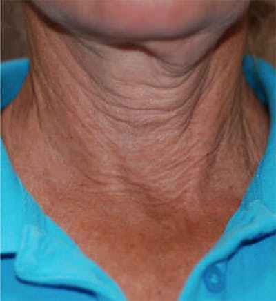 Exilis Ultra Before & After Gallery - Patient 9605659 - Image 1