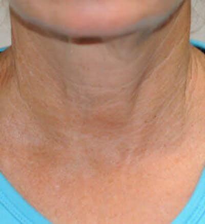 Exilis Ultra Before & After Gallery - Patient 9605659 - Image 2