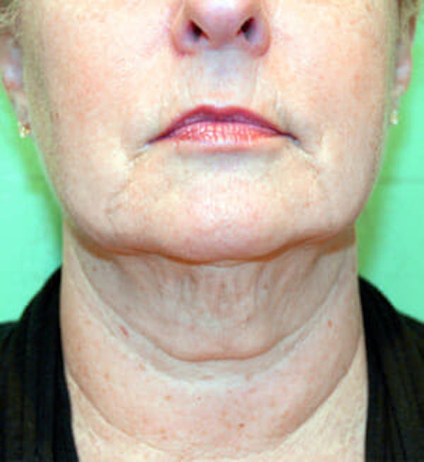 Exilis Ultra Before & After Gallery - Patient 9605662 - Image 1