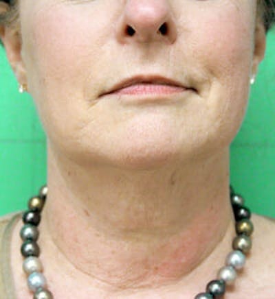 Exilis Ultra Gallery - Patient 9605662 - Image 2
