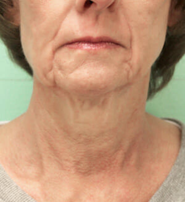 woman's neck before
