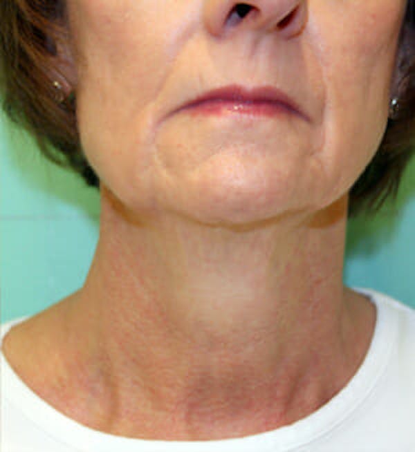 woman's neck after