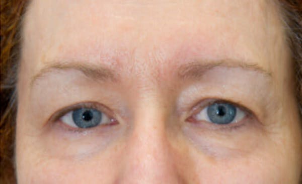 Exilis Ultra Before & After Gallery - Patient 9605671 - Image 2