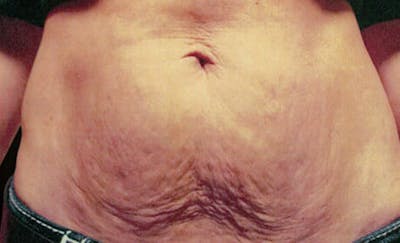 Exilis Ultra Before & After Gallery - Patient 9605672 - Image 1