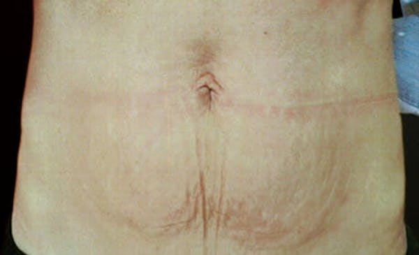 Exilis Ultra Before & After Gallery - Patient 9605672 - Image 2
