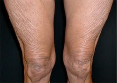 Exilis Ultra Before & After Gallery - Patient 9605673 - Image 1