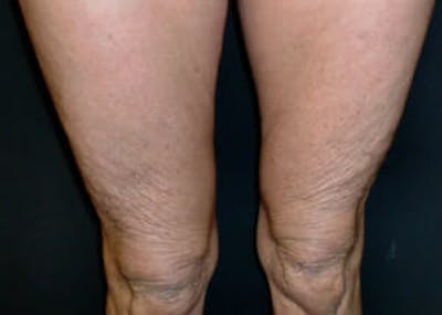 Exilis Ultra Before & After Gallery - Patient 9605673 - Image 2