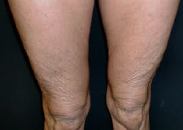 Exilis Ultra Before & After Gallery - Patient 9605673 - Image 2