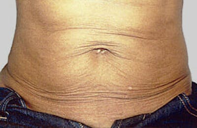 Exilis Ultra Before & After Gallery - Patient 9605674 - Image 1