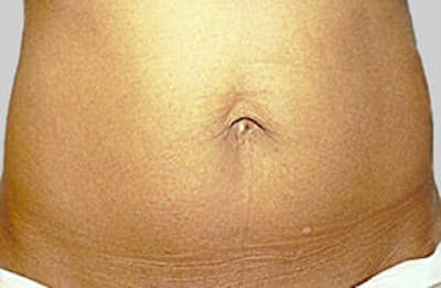 Exilis Ultra Before & After Gallery - Patient 9605674 - Image 2