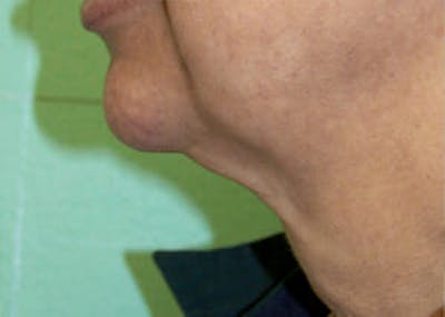 Exilis Ultra Before & After Gallery - Patient 9605675 - Image 1