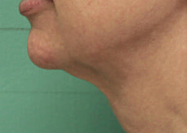 Exilis Ultra Before & After Gallery - Patient 9605675 - Image 2