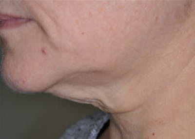 Exilis Ultra Before & After Gallery - Patient 9605676 - Image 1