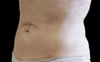 CoolSculpting® Elite Before & After Gallery - Patient 9605677 - Image 4