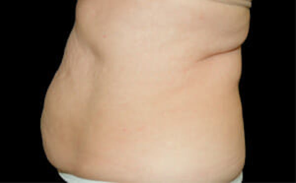 CoolSculpting® Elite Before & After Gallery - Patient 9605680 - Image 1