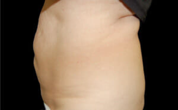CoolSculpting® Elite Before & After Gallery - Patient 9605680 - Image 2