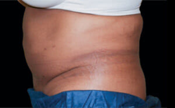 CoolSculpting® Elite Before & After Gallery - Patient 9605681 - Image 1