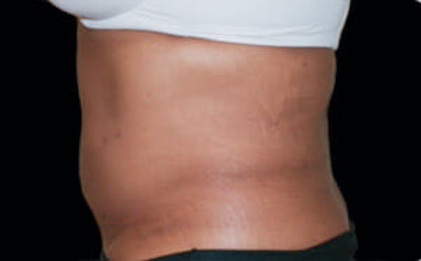 CoolSculpting® Elite Before & After Gallery - Patient 9605681 - Image 2