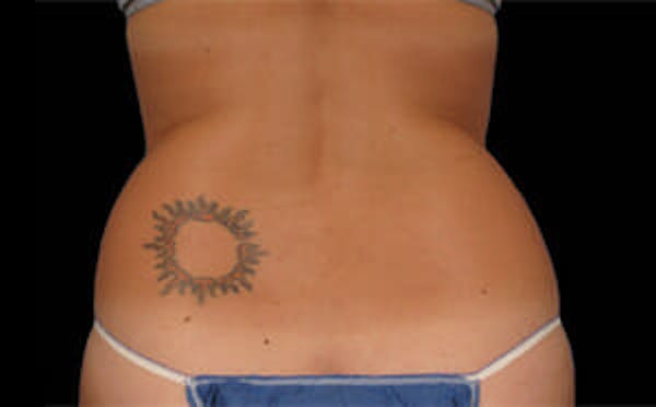 CoolSculpting® Elite Before & After Gallery - Patient 9605682 - Image 1