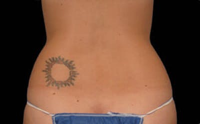 CoolSculpting® Gallery - Patient 9605682 - Image 2