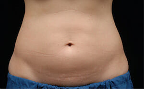 CoolSculpting® Elite Before & After Gallery - Patient 9605684 - Image 1