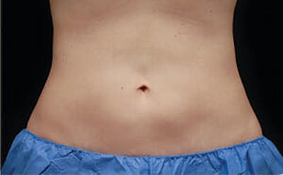 CoolSculpting® Elite Before & After Gallery - Patient 9605684 - Image 2