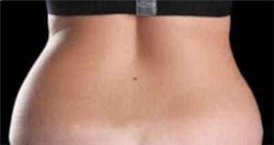 CoolSculpting® Elite Before & After Gallery - Patient 9605686 - Image 1
