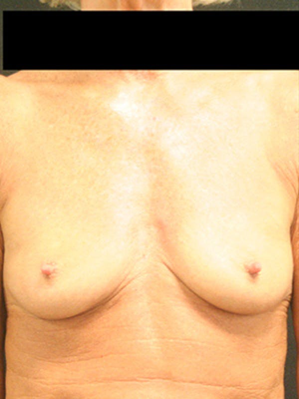 Breast Augmentation Before & After Gallery - Patient 9605695 - Image 1