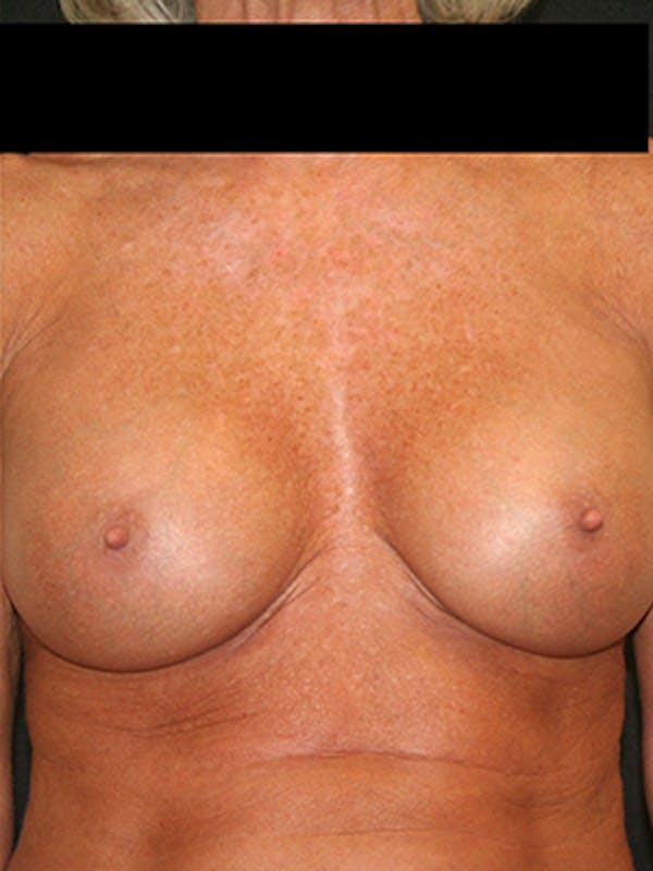Breast Augmentation Before & After Gallery - Patient 9605695 - Image 2