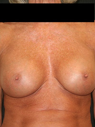 Breast Augmentation Before & After Gallery - Patient 9605695 - Image 2