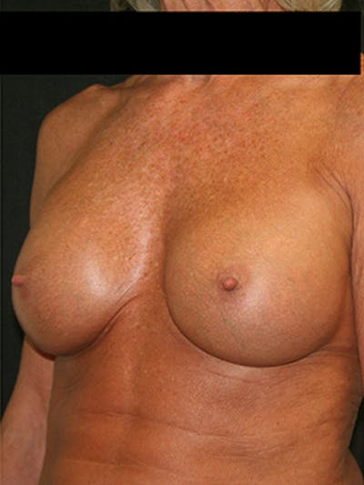 Breast Augmentation Before & After Gallery - Patient 9605695 - Image 4