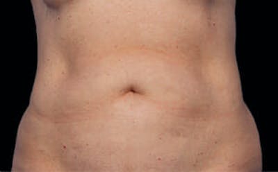 CoolSculpting® Elite Before & After Gallery - Patient 9605688 - Image 1