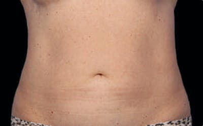 CoolSculpting® Gallery - Patient 9605688 - Image 2