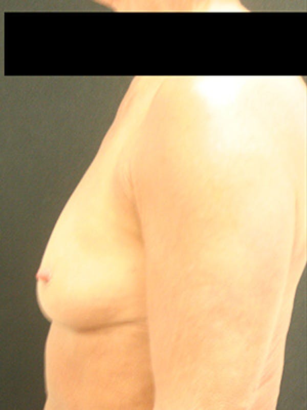 Breast Augmentation Before & After Gallery - Patient 9605695 - Image 5