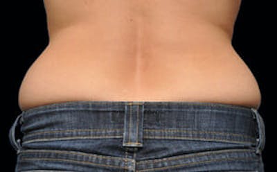 CoolSculpting® Elite Before & After Gallery - Patient 9605696 - Image 1