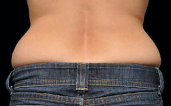 CoolSculpting® Elite Before & After Gallery - Patient 9605696 - Image 1